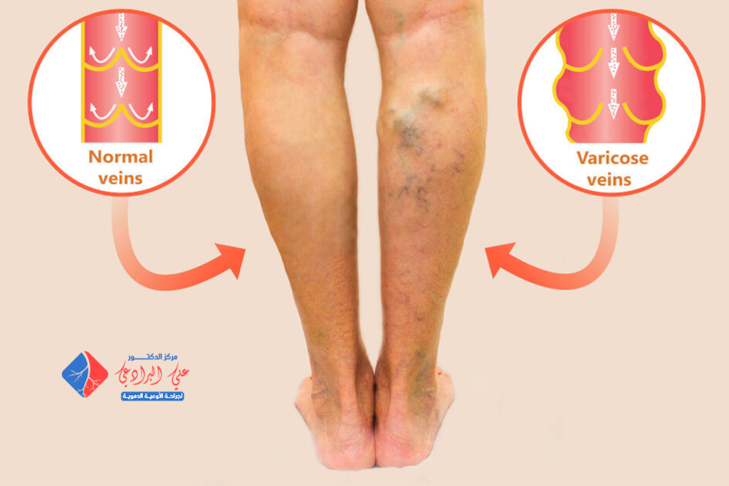 علاج دوالي الساقين بدون جراحة