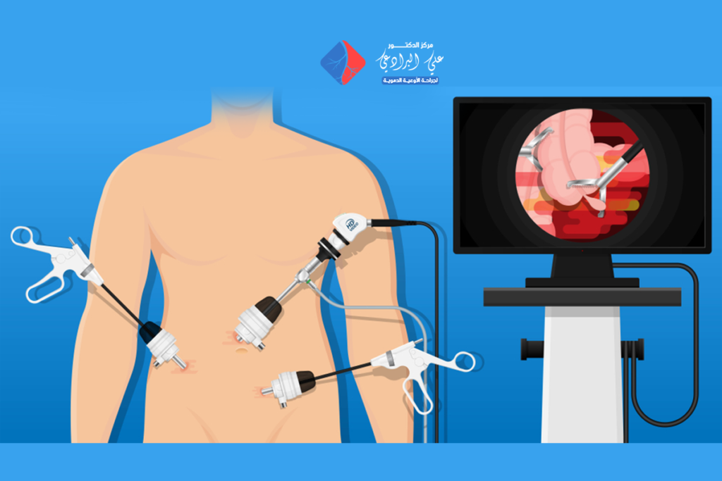 تكلفة عملية المرارة بالمنظار​