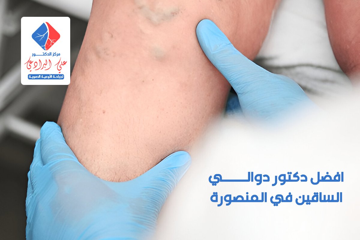 افضل دكتور دوالي الساقين في المنصورة