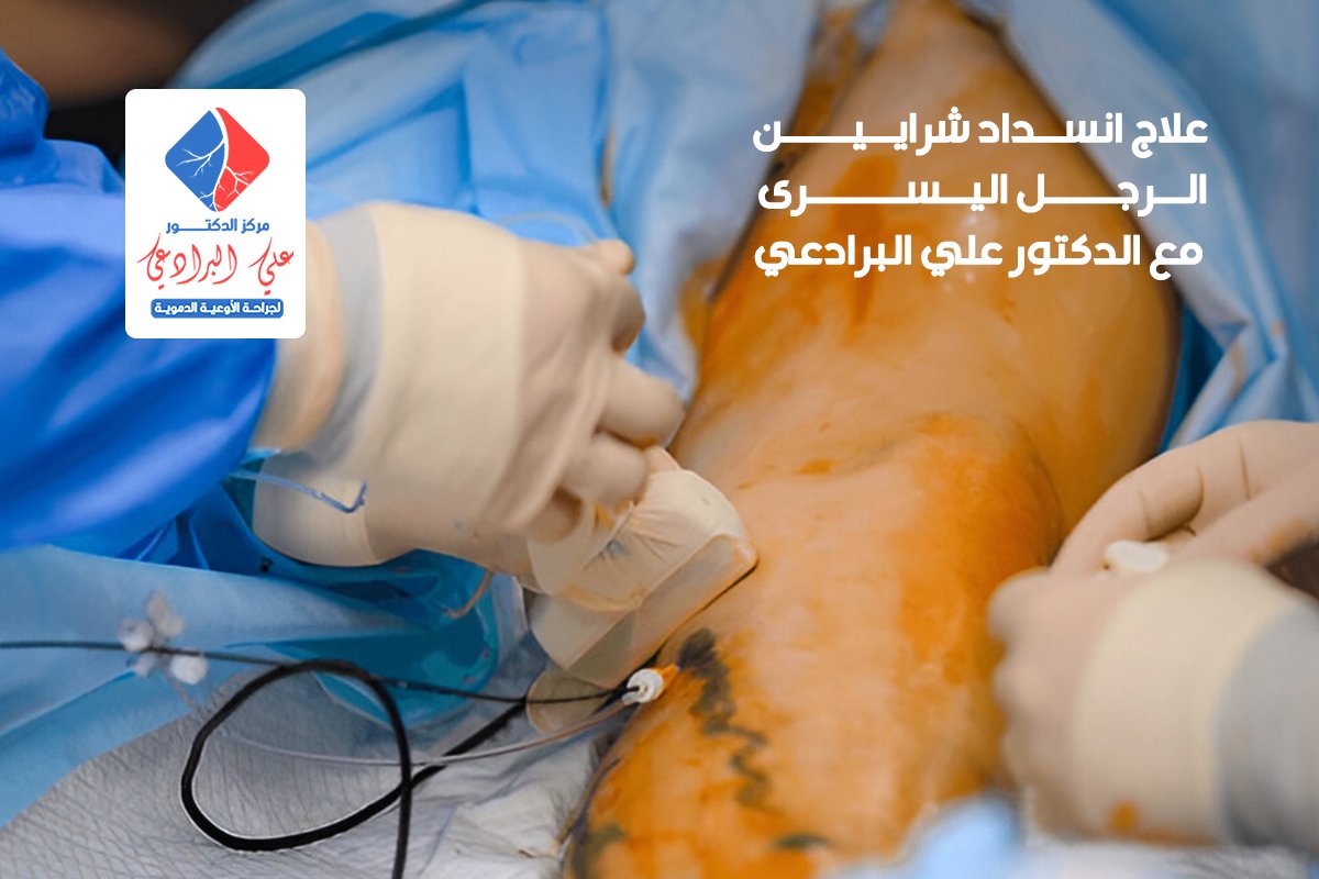علاج انسداد شرايين الرجل اليسرى