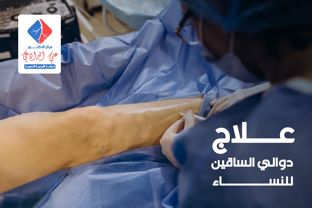 علاج دوالي الساقين للنساء