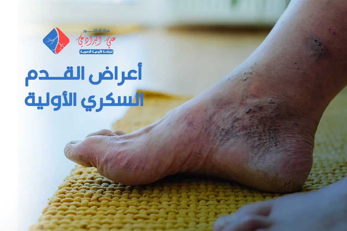 أعراض القدم السكري الأولية (3)