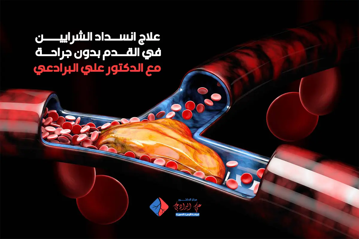 علاج انسداد الشرايين في القدم بدون جراحة